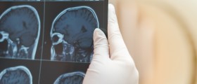 Diagnosing Multiple Sclerosis With Magnetic Resonance Imaging (MRI)